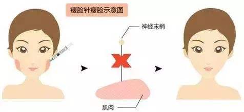咬肌肥大要如何解決？