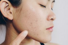 痤瘡的中醫(yī)治療方法如何